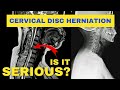 Is A Cervical Disc Herniation Serious? | Dr. Walter Salubro Chiropractor in Vaughan