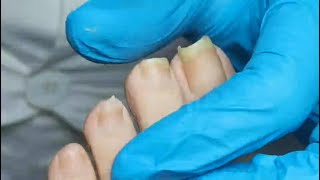 Curved nails were removed by pedicurist. Fungal nail treatment &amp; ingrown toenails removal.