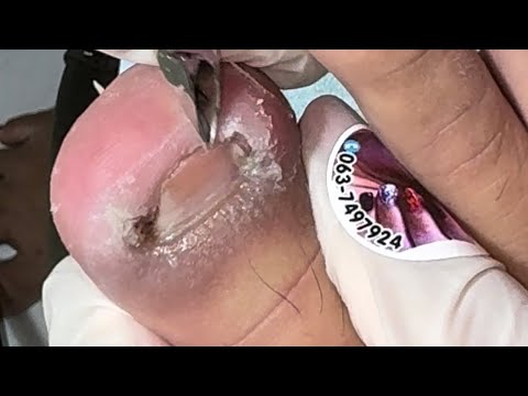 Ep_6231 Ingrown toenail removal 👣 ทำไมผมต้องรั้งเนื้อครับ 😄 (clip from Thailand)