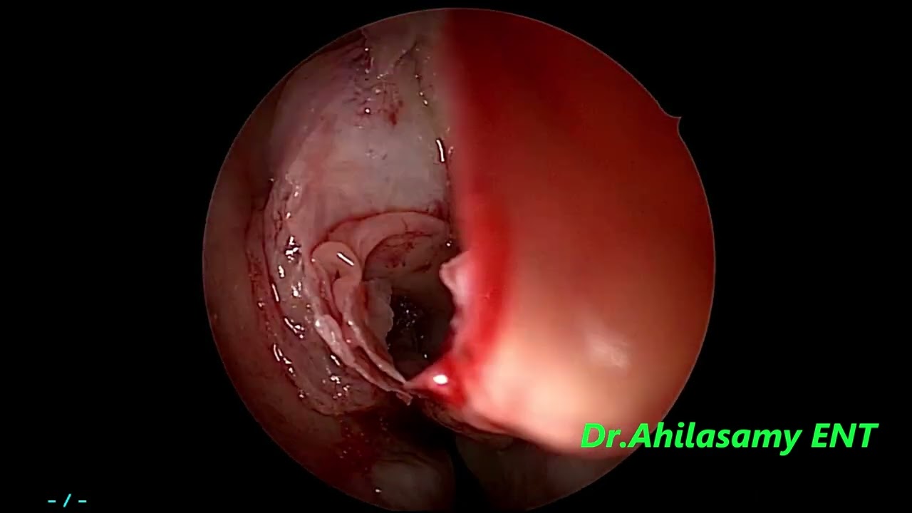(B) CRSwNP Polyposis-(B) Full house FESS under LA