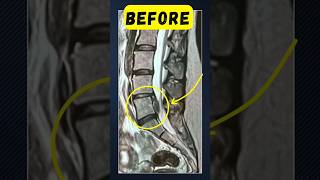 Severe Foot Drop Recovery (No Surgery) – Real Result