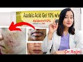 How To Use Azelaic Acid Gel 10% Correctly | Aziderm 10% Cream Review | Doctor Rajni | #azelaicacid