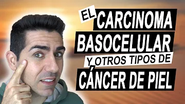 ¿A qué edad se desarrolla el carcinoma escamoso?