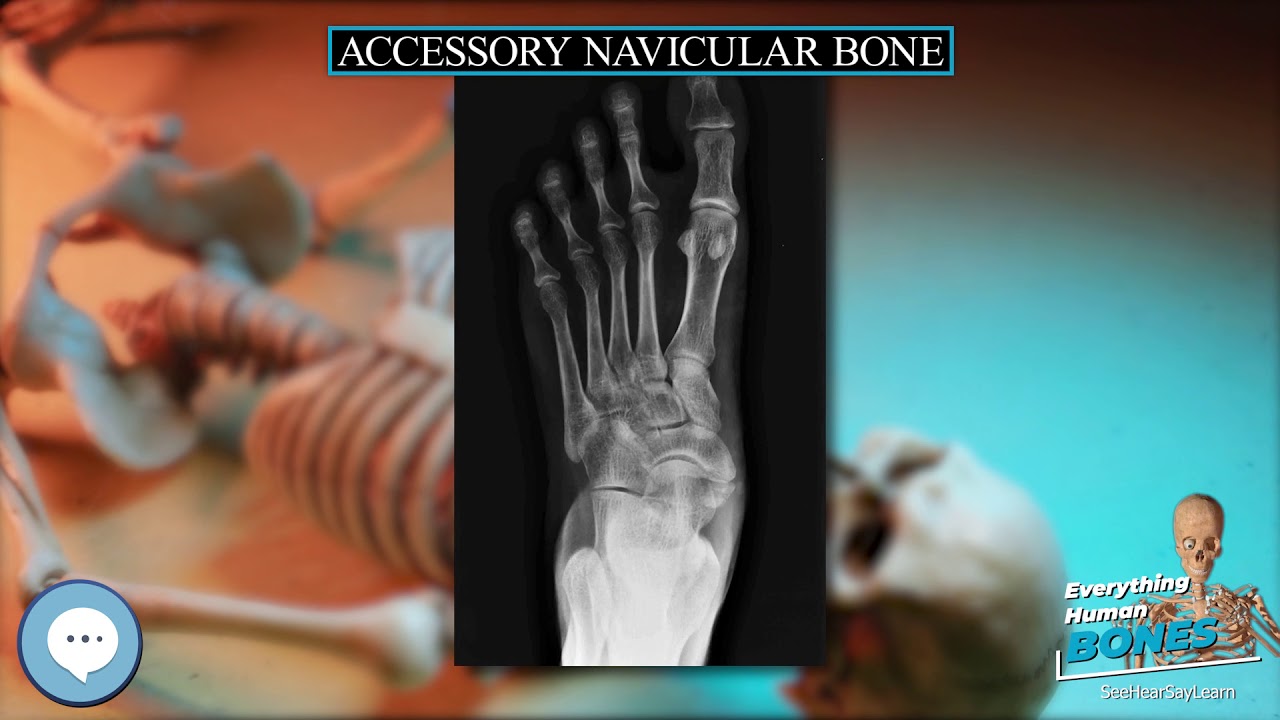 Accessory navicular bone 🦴 Everything Human Anatomy Bones 🦴 YouTube