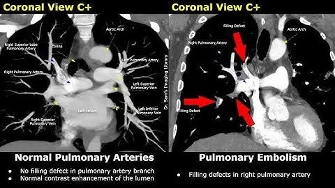 CT Pulmonary Angiography + DVT Protocol | Step-by-Step Guide.@avnishradiology