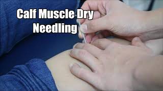 Calf Muscle Dry Needling | Triumph Physio