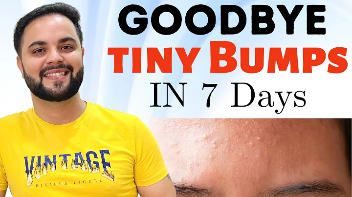 7 Days Clear Skin Challenge ||Clear Tiny Bumps from Forehead & Face