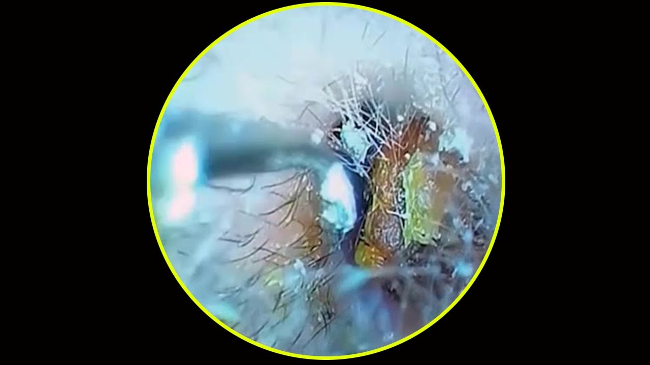 Huge Ear Wax Removal Dr Zhao at Martin Novotny blog