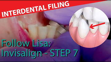🦷 Follow Lisa: Invisalign 7 - Interdental filing or Interproximal reduction