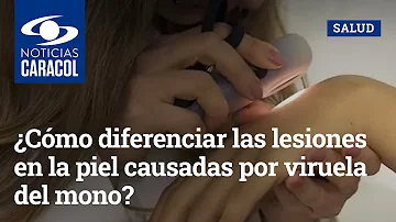 ¿Qué es la cara picada de viruela?