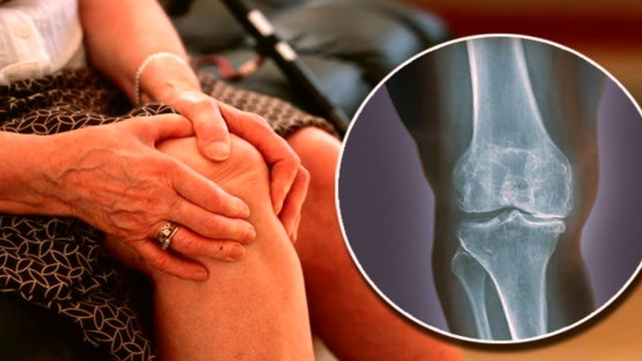 best arthritis treatment in kenya