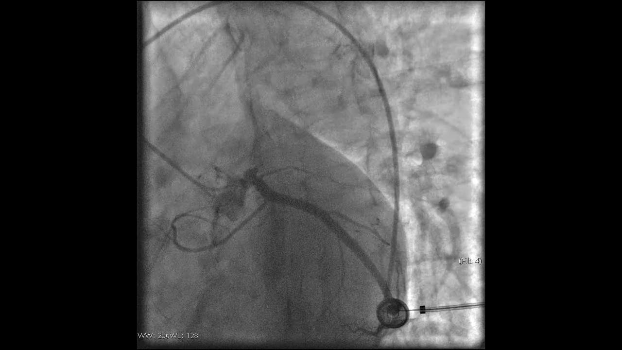 Стентирование видео. Коронарография стентирование. Операция на сердце коронарография и стентирование. Коронографияистэнтирование. Коронарография компрессионная манжета.