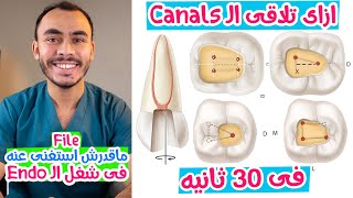 Tips and Tricks to find Endodontic Root Canal After Access Cavity Preparation