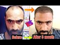 3 Month Hair Transplant Result | Day by Day Hair Growth | Part 1