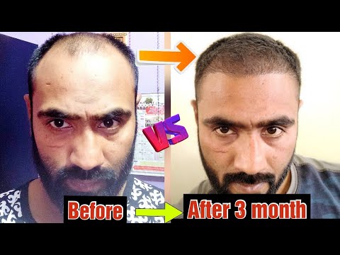 3 Month Hair Transplant Result | Day by Day Hair Growth | Part 1 - YouTube