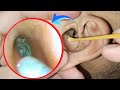 You Won’t Believe What Came Out of This Infected Ear! 😱 | Deep Ear Wax Removal ASMR | EP 33