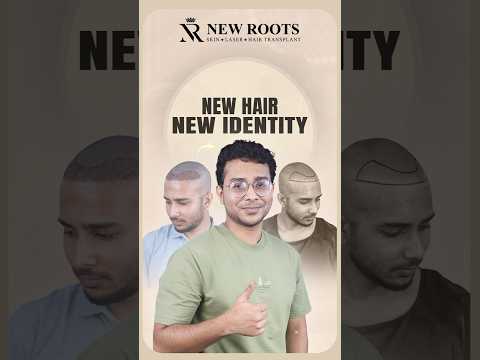 Hair Transplant in Bangladesh (Grade 3 Baldness) | Bangla #hairtransplant #bangladesh #shorts