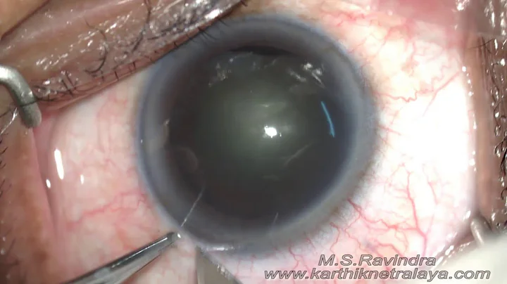 Cataract in India