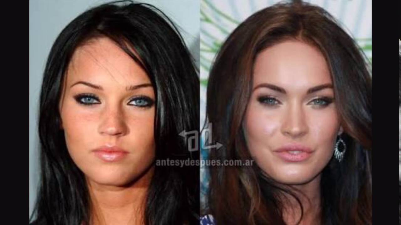 Surgery before and after. cirugias, fotos antes y despues, famosos antes y...