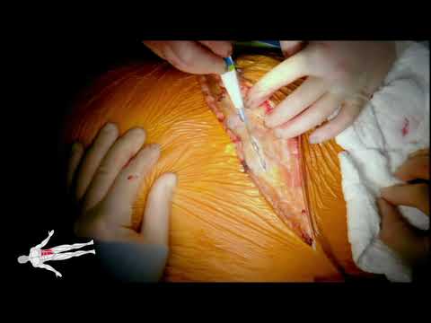 Video: Bypass Aortobifemorale: Chirurgia, Procedura E Complicanze