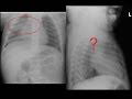 Lung US and CXR Pneumonia Correlation: 1 y.o. F with Fever, Cough and Tachypnea
