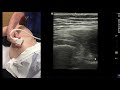 Ultrasound examination of the lateral hip