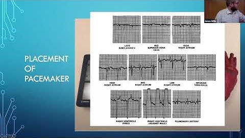 Dr. McMahon - "Transvenous Pacing"