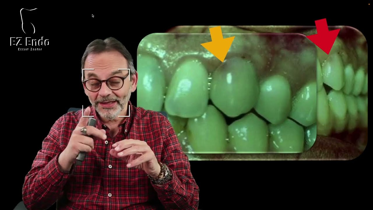 تآكل جذور الأسنان الداخلي - التشخيص والعلاجInternal Root Resorption - Diagnosis & Treatment