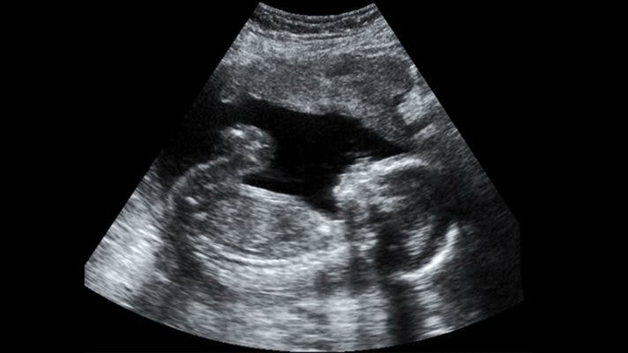 Vanishing Twin Syndrome