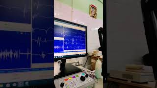 #fibrillation in #emg spontaneous potential in EMG are a sign of denervation of a muscle fiber