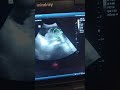 Succenturiate placenta Accessory Lobe | Placenta previa | Abruption | fetus Pregnancy | Radiologist
