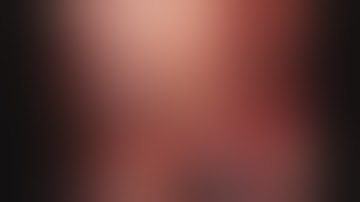 Asvide: Robotic subxiphoid thymectomy