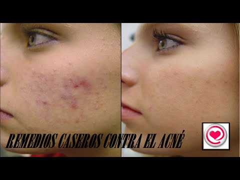 Remedios Caseros: Como hacer mascarillas naturales para combatir el acné - Todo en Uno