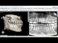 Semana 4  cmo localizar el conducto dentario inferior utilizando el software blue sky plan