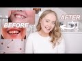 MY INVISALIGN JOURNEY 2021⚡️ WHAT TO EXPECT, BEFORE & AFTER, PRICE etc