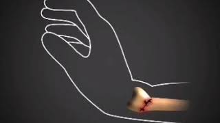 Common Radial Fractures