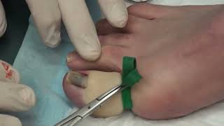 BIG Toenail - Partial Removal