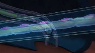 Mechanism of Iovera treatment to reduce pain in osteoarthritis and totalknee replacement