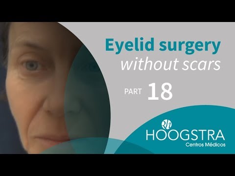 blepharoplasty laser Eyelid surgery without scars - Part 18