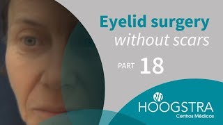 Eyelid surgery without scars - Part 18