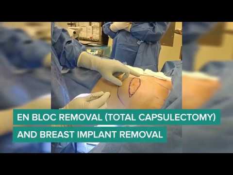 En Bloc Removal (Total Capsulectomy) and Breast Implant Removal - MBAS