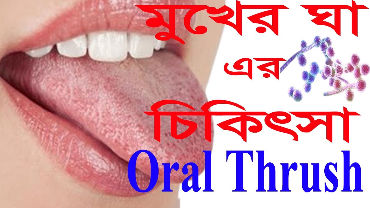 Treatment For Oral Thrush Oral Thrush Treatment Over The Counteroral