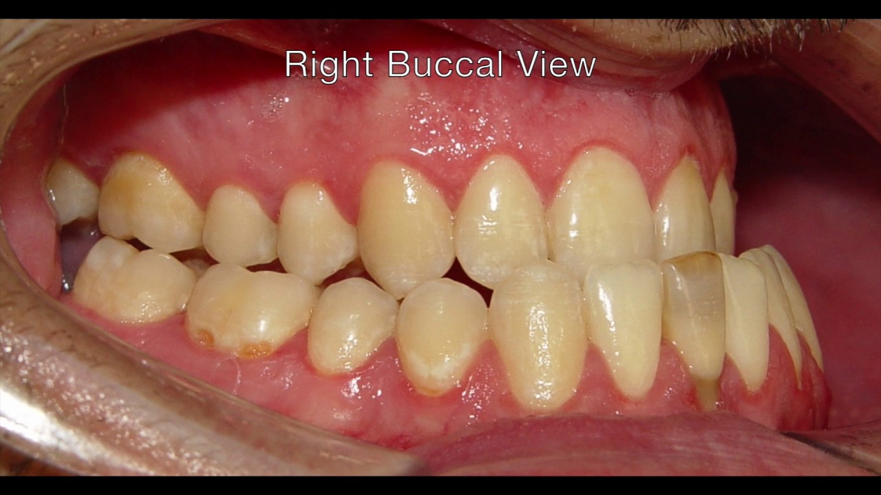 Orthodontic Treatment of Sever Skeletal Class III - Mohammad - YouTube