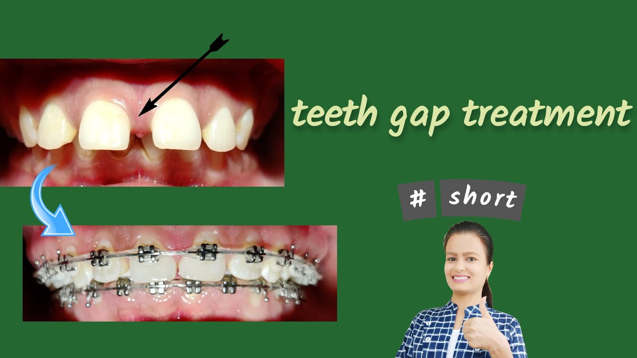 teeth gap treatment Braces Dental Clinic