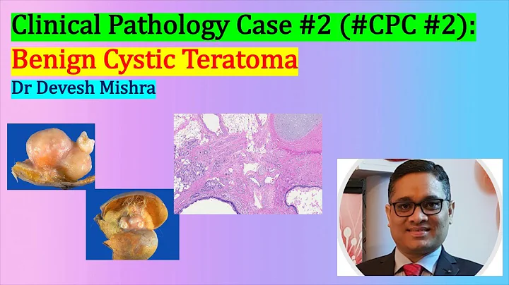 Clinical Pathology Case #2 (#CPC #2):Benign Cystic Teratoma Dr Devesh Mishra - DayDayNews