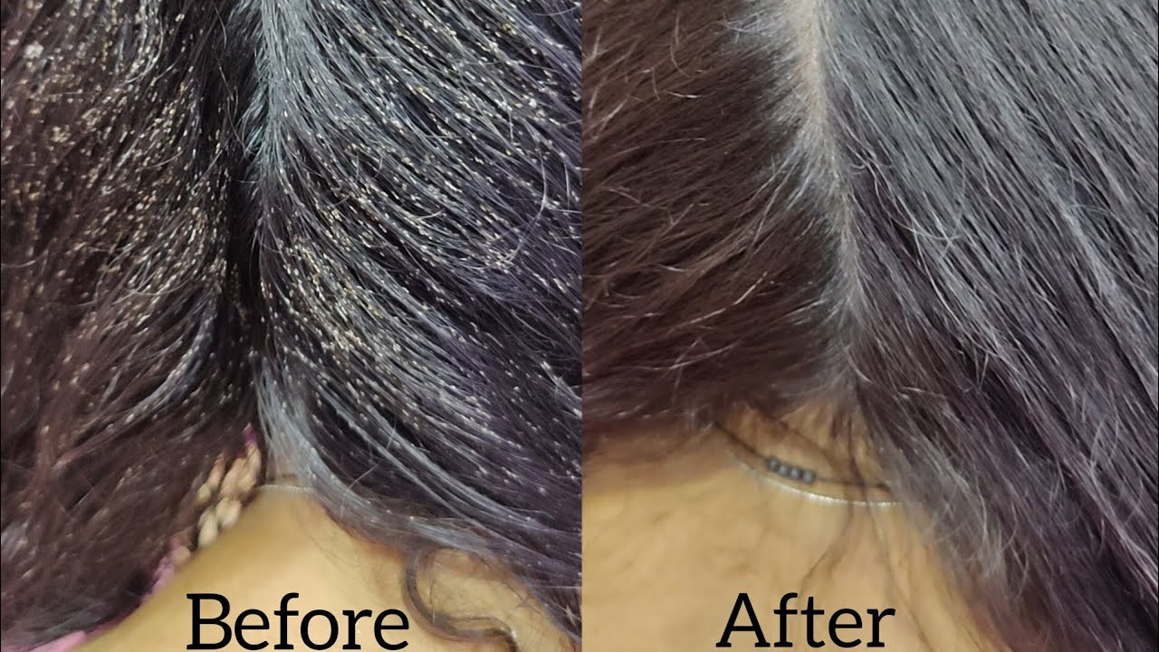 Nits & lice treatment available here 100 result for one sitting ️ no side effects 💯 YouTube