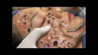 00001# Amazing Acne Treatment & Blackhead Removal 2026 screenshot 3