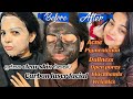 Carbon laser treatment    skin  best treatment for clear skinacne