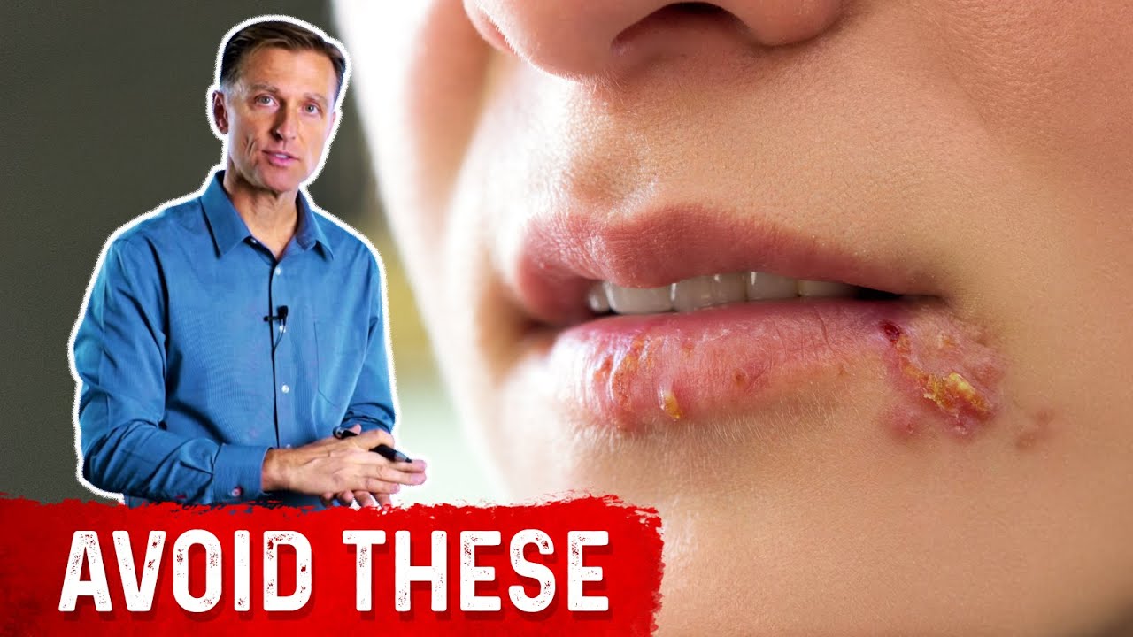 Avoid These Foods If You Have Herpes - YouTube