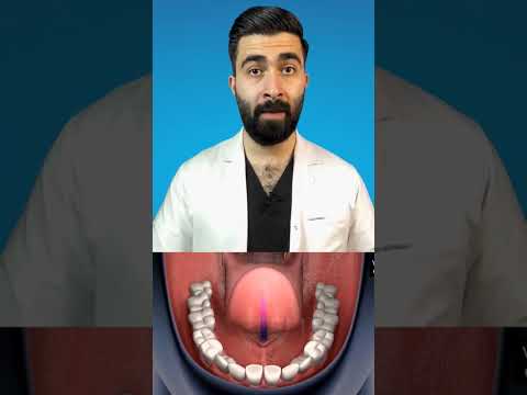 بلع اللسان